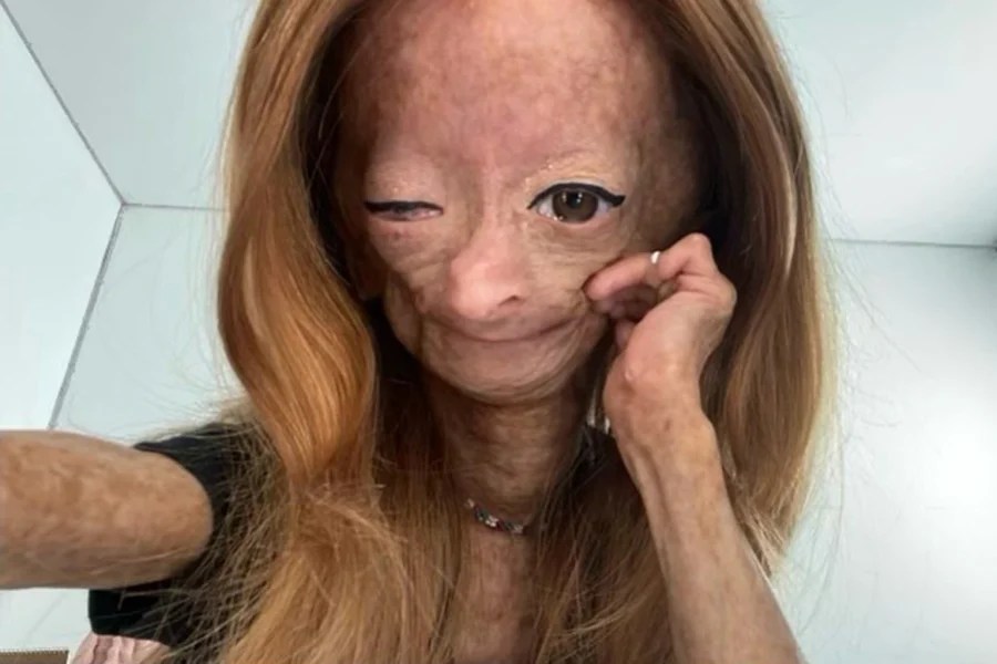 Adalia Rose Williams dies